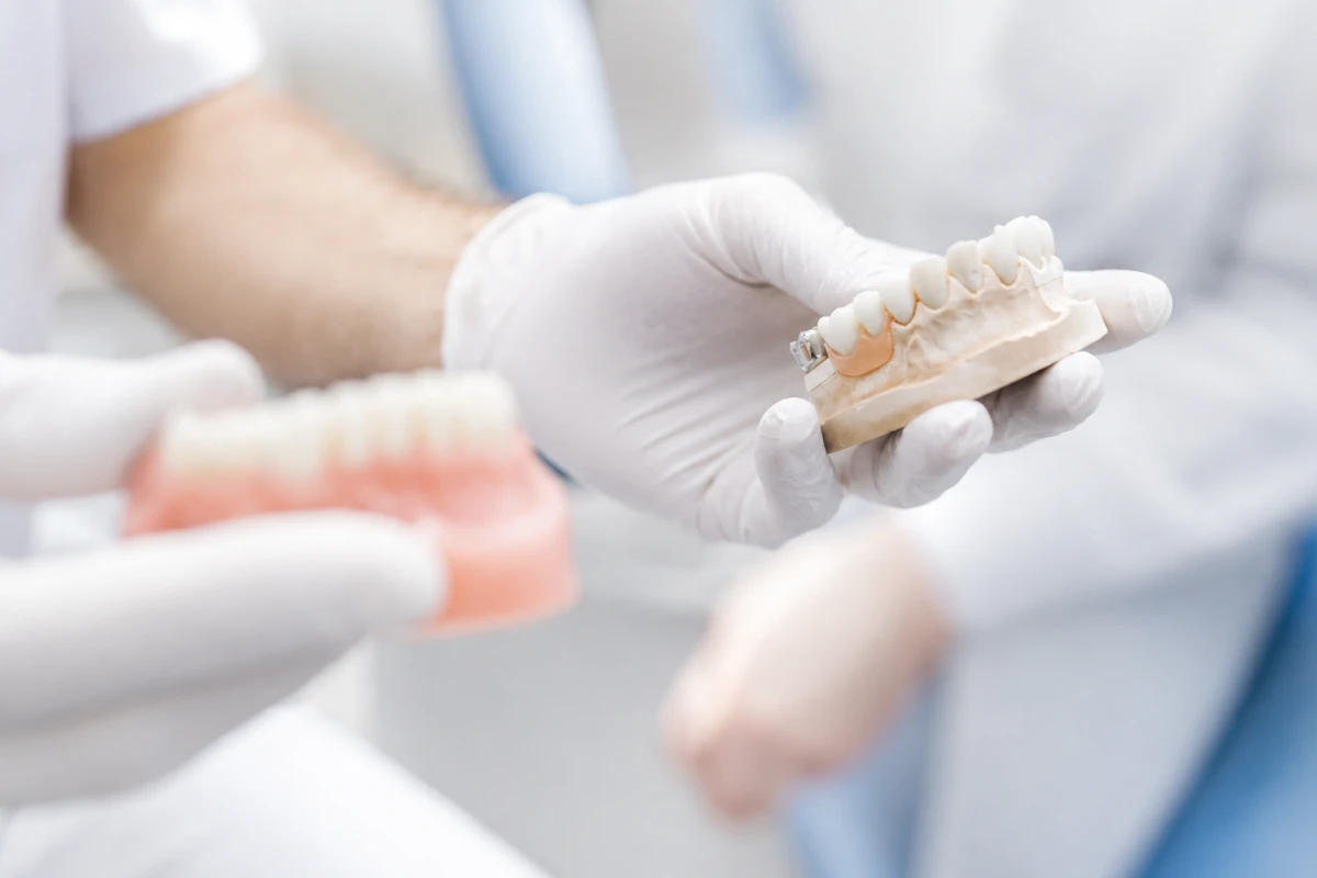 Implantes Dentários